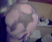 alopezia-areata