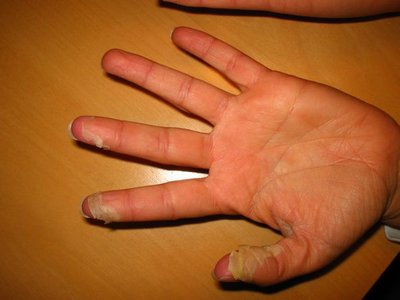 scharlach: hautschuppung hand