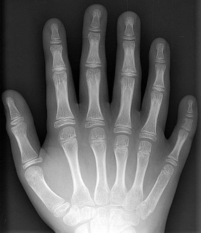 polydaktylie röntgenbild