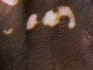 Penis pigmentstörung Vitiligo (Weißfleckenkrankheit)
